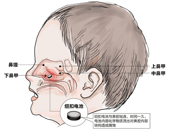 上海發(fā)布兒童電子產(chǎn)品風(fēng)險預(yù)警 部分存在電池吞咽風(fēng)險